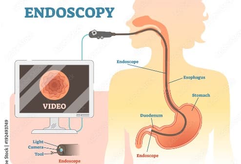 Endoscopy