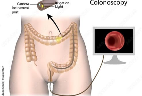 Colonoscopy