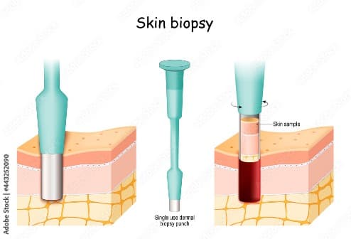 Biopsy